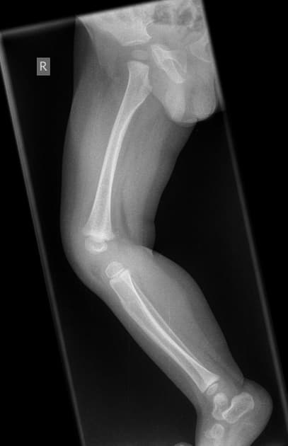 Lower Limb Pediatric
